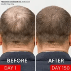 Scalp Renewal System