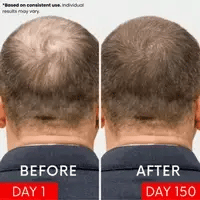 Scalp Renewal System